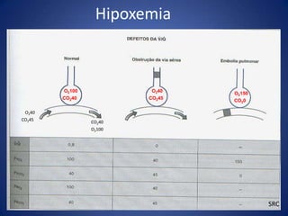 Hipoxemia



        O2100            O240   O2150
        CO240           CO245   CO20

 O240
CO245
                CO240
                O2100




                                        SRC
 