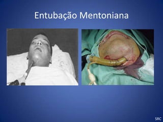 Entubação Mentoniana




                       SRC
 