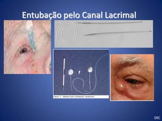 Entubação pelo Canal Lacrimal




                                SRC
 