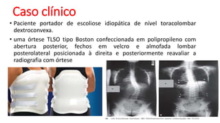 Caso clínico
• Paciente portador de escoliose idiopática de nível toracolombar
dextroconvexa.
• uma órtese TLSO tipo Boston confeccionada em polipropileno com
abertura posterior, fechos em velcro e almofada lombar
posterolateral posicionada à direita e posteriormente reavaliar a
radiografia com órtese
 