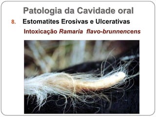 Patologia da Cavidade oralEstomatites Erosivas e UlcerativasIntoxicação Ramaria  flavo-brunnencens