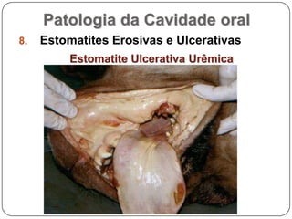 Patologia da Cavidade oralEstomatites Erosivas e UlcerativasEstomatite Ulcerativa Urêmica