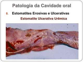 Patologia da Cavidade oralEstomatites Erosivas e UlcerativasEstomatite Ulcerativa Urêmica
