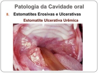 Patologia da Cavidade oralEstomatites Erosivas e UlcerativasEstomatite Ulcerativa Urêmica