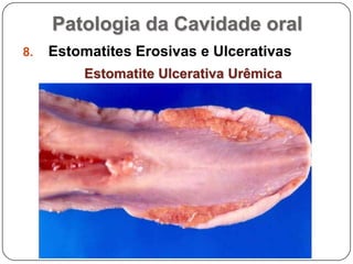 Patologia da Cavidade oralEstomatites Erosivas e UlcerativasEstomatite Ulcerativa Urêmica