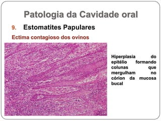 Patologia da Cavidade oralEstomatites PapularesEctima contagioso dos ovinosHiperplasia do epitélio formando colunas que mergulham no córion da mucosa bucal