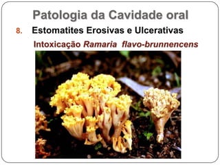 Patologia da Cavidade oralEstomatites Erosivas e UlcerativasIntoxicação Ramaria  flavo-brunnencens
