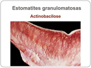 Estomatites granulomatosasActinobacilose