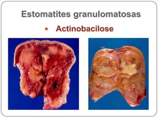Estomatites granulomatosasActinobacilose