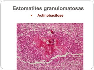 Estomatites granulomatosasActinobacilose