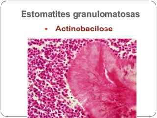 Estomatites granulomatosasActinomicose