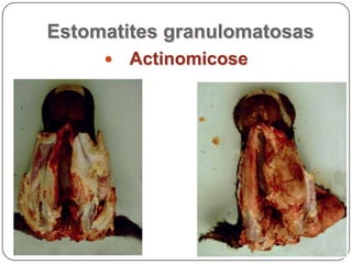 Estomatites granulomatosasActinomicose