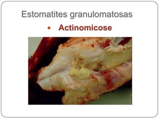 Estomatites granulomatosasActinomicose