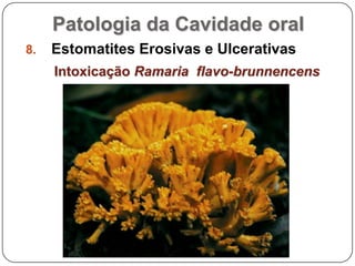 Patologia da Cavidade oralEstomatites Erosivas e UlcerativasIntoxicação Ramaria  flavo-brunnencens