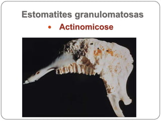 Estomatites granulomatosasActinomicose
