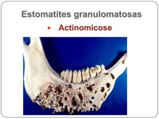 Patologia da Cavidade OralIntroduçãoEstrutura e funçãoMecanismos de defesaAnomalias do desenvolvimentoEstomatites e gengivitesEstomatites vesicularesDoenças vesiculares especificasEstomatites erosivas e ulcerativasEstomatites papulares