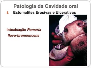 Patologia da Cavidade oralEstomatites Erosivas e UlcerativasIntoxicação Ramaria flavo-brunnencens