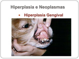 Patologia da Cavidade oralHiperplasias e Neoplasiasa) Doenças HiperplásicasEpulis  ou EpulidesNeoplasma benigno (ligamento periodental)Tipos Epúlides por histopatologia:Fibromatoso,Acantomatoso,OssificanteCélulas gigantes
