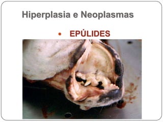 Hiperplasia e NeoplasmasEpúlides Acantomatoso