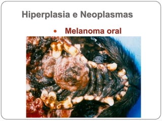 Hiperplasia e NeoplasmasPapilomas oral