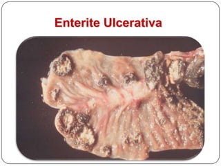 Inflamações:Tipo de ExsudatoHemorrágicaCatarralGranulomatosa / ProliferativaUlcerativa / necrotizanteParasitária