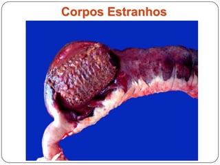 Obstrução Intestinal por Corpo Estranho