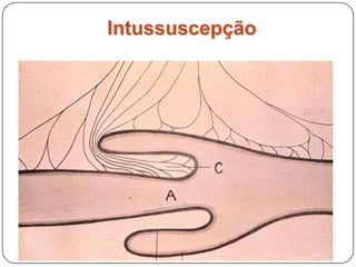 Intussuscepção
