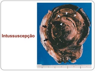 IntussuscepçãoCausasDiferenciar Ante e posmorten