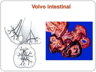 Volvo Intestinal