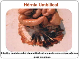 Hérnia diafragmática