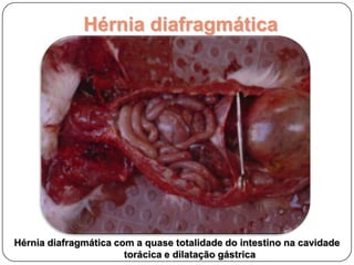 Hérnia Diafragmática