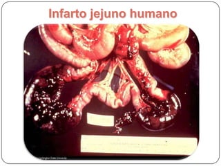 Inflamação intestinosEnteriteLocalização anatômica + iteExtensãoSegmentar, DifusaIntensidadeDiscreta, Moderada, AcentuadaExsudatoCatarral, hemorrágico, purulento, fibrinosoEtiologiaVírus, bactérias, fungos, parasitos