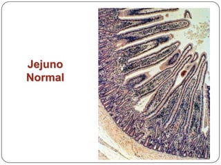 Jejuno Normal