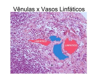 Vênulas x Vasos Linfáticos
 