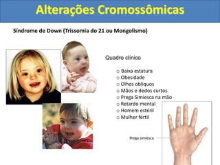 Síndrome de Down (Trissomia do 21 ou Mongolismo)
Quadro clínico
o Baixa estatura
o Obesidade
o Olhos oblíquos
o Mãos e dedos curtos
o Prega Simiesca na mão
o Retardo mental
o Homem estéril
o Mulher fértil
Alterações Cromossômicas
 