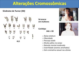 Síndrome de Turner (X0)
Só ocorre
em mulheres
Cariótipo
44A + X0
o Baixa estatura
o Obesidade
o Pescoço alado
o Muitos pêlos no corpo
o Retardo mental moderado
o Esterilidade (ovários atrofiados)
o Sem cromatina sexual nas células
Alterações Cromossômicas
 