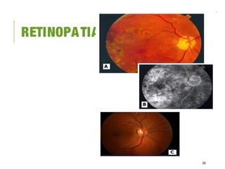 RETINOPATIA
28
 