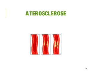 ATEROSCLEROSE
29
 