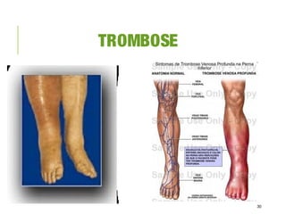TROMBOSE
30
 