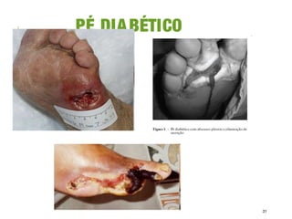 PÉ DIABÉTICO
31
 