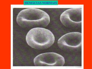 HEMÁCIAS NORMAIS 
