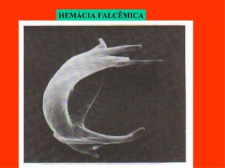 HEMÁCIA FALCÊMICA 