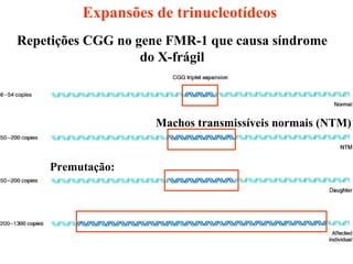 Expansões de trinucleotídeos Repetições CGG no gene FMR-1 que causa síndrome do X-frágil Premutação: Machos transmissíveis normais (NTM) 