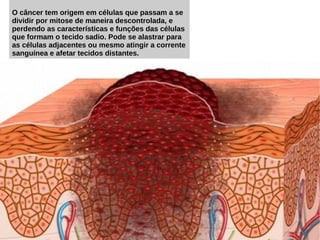 O câncer tem origem em células que passam a se
dividir por mitose de maneira descontrolada, e
perdendo as características e funções das células
que formam o tecido sadio. Pode se alastrar para
as células adjacentes ou mesmo atingir a corrente
sanguínea e afetar tecidos distantes.
 