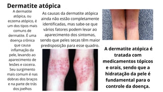 Dermatite atópica
A dermatite
atópica, ou
eczema atópico, é
um dos tipos mais
comuns de
dermatite. É uma
doença crônica
que causa
inflamação da
pele, levando ao
aparecimento de
lesões e coceira.
Seu surgimento
mais comum é nas
dobras dos braços
e na parte de trás
dos joelhos
As causas da dermatite atópica
ainda não estão completamente
identificadas, mas sabe-se que
vários fatores podem levar ao
aparecimento dos sintomas,
sendo que peles secas têm maior
predisposição para esse quadro.
A dermatite atópica é
tratada com
medicamentos tópicos
e orais, sendo que a
hidratação da pele é
fundamental para o
controle da doença.
 