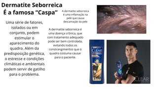 Dermatite Seborreica
É a famosa “Caspa” A dermatite seborreica
é uma inflamação na
pele que causa
descamação da pele
A dermatite seborreica é
uma doença crônica, que
com tratamento adequado
pode ser bem controlada,
evitando todos os
constrangimentos que o
quadro costuma causar
para o paciente.
Uma série de fatores,
isolados ou em
conjunto, podem
estimular o
aparecimento do
quadro. Além da
predisposição genética,
o estresse e condições
climáticas e ambientais
podem servir de gatilho
para o problema.
 