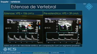 Estenose de Vertebral
Estenose: VPS = 106 cms Pre-estenótico: VPS = 39 cm/s
101
dobro do pico de velocidade sistólica, em comparação com um segmento proximal
Doppler - vertebrais
Dr. Carlos Stéfano Hoffmann Britto @drcarlosstefano stefanobritto@hotmail.com (31) 98799-0405
 