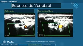 Estenose de Vertebral
Estenose: Pos-estenótico
102
Corte transversal com power Doppler
Doppler - vertebrais
Dr. Carlos Stéfano Hoffmann Britto @drcarlosstefano stefanobritto@hotmail.com (31) 98799-0405
 