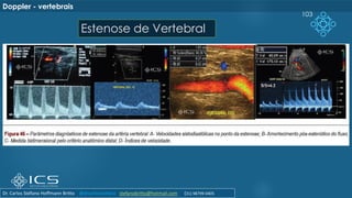103
Doppler - vertebrais
Estenose de Vertebral
Dr. Carlos Stéfano Hoffmann Britto @drcarlosstefano stefanobritto@hotmail.com (31) 98799-0405
 