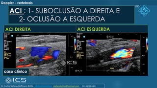 ACI : 1- SUBOCLUSÃO A DIREITA E
2- OCLUSÃO A ESQUERDA
ACI DIREITA ACI ESQUERDA
105
Doppler - vertebrais
caso clínico
Dr. Carlos Stéfano Hoffmann Britto @drcarlosstefano stefanobritto@hotmail.com (31) 98799-0405
 